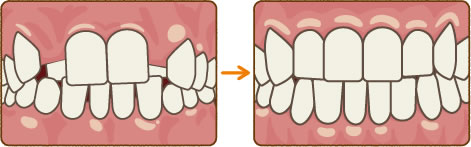 バイオブロックセラピー代表例 【歯列不正】