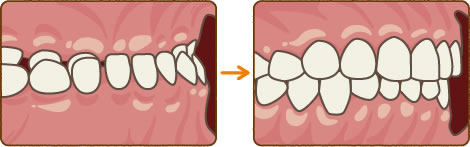 ランパセラピー代表例 【受け口】